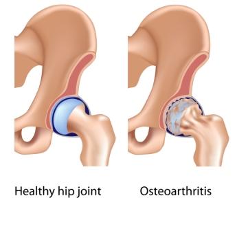 Healthy Hip and Osteoarthritic Hip